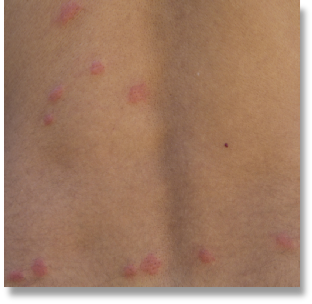 NH Bed bug bites can cause welts and rashes that itch and cause discomfort.